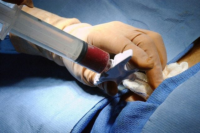Trapianto di staminali blocca la sclerosi multipla per anni, ma la terapia è ad alto rischio