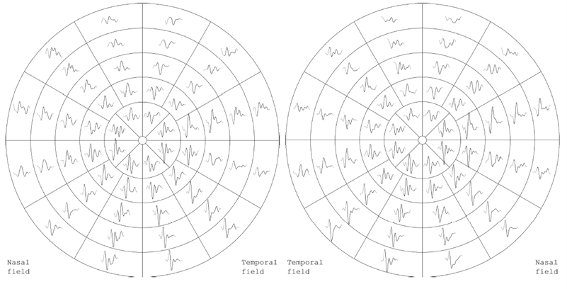 UTILITA’ DEI MULTIFOCAL VEP